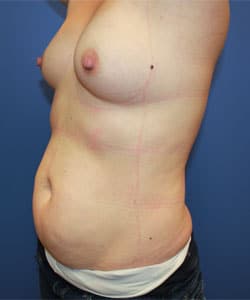 Liposuction Salt Lake City