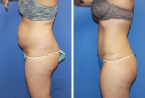 Tummy Tuck in Salt Lake City, Abdominoplasty