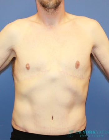 Plastic Surgery After Weight Loss Utah