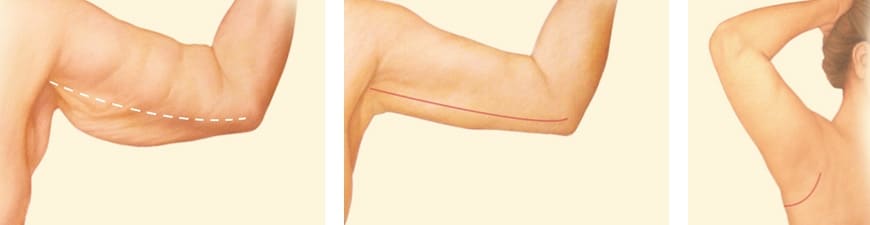 Arm Lift Surgery in Salt Lake City UT Dr. York Yates