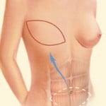 Breast Reconstruction 03 150x150 1