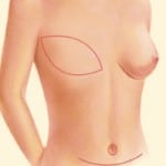 Breast Reconstruction 04 150x150 1