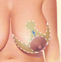 Anchor Scar Pattern “Classic” Technique Breast Reduction