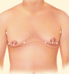 Breast Reduction for Men 01