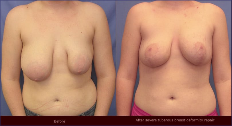 Tuberous breast reconstruction