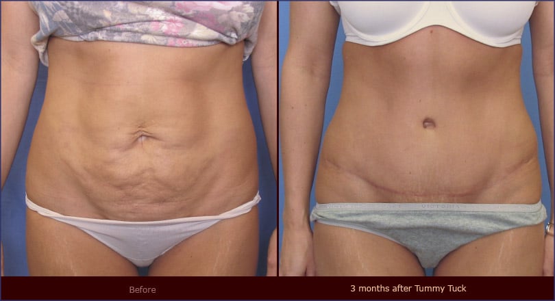 Liposuction in Salt Lake City, UT