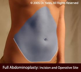 abdominoplasty photo