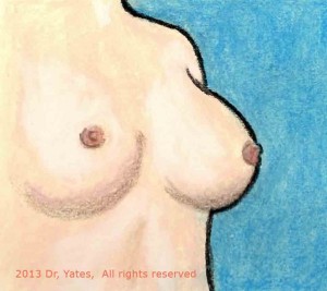 implant breast art1 300x267 1
