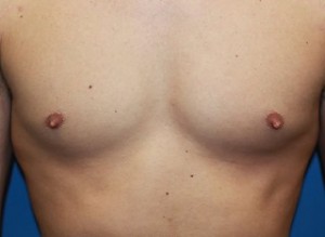 nipple pre2 300x219 1