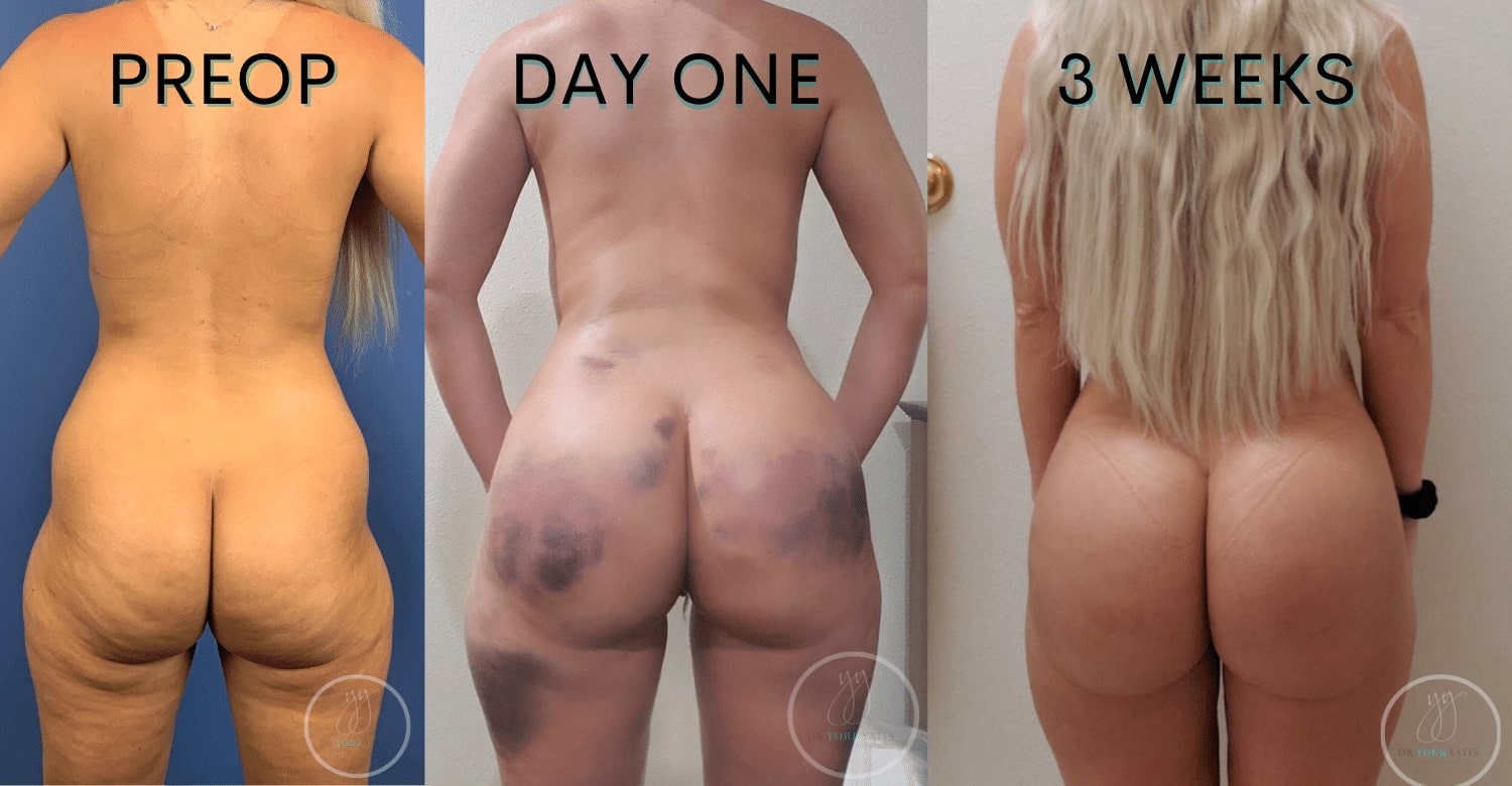 Buttock Augmentation/Brazilian Butt Lift Before and After Pictures Case 262, Austin, TX