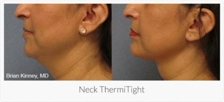 Neck ThermiTight w caption e1505312372413