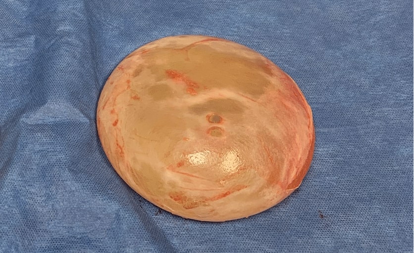 Breast Implant Removal