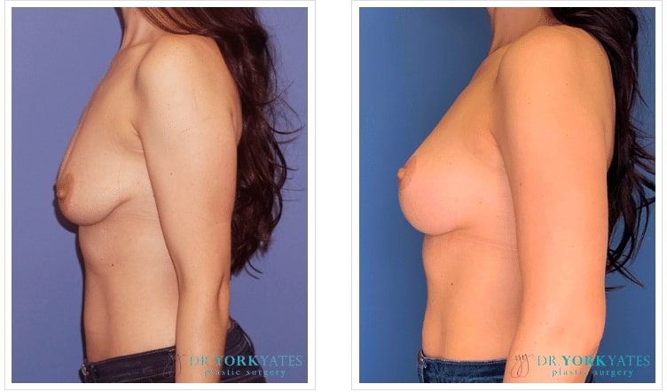 Breast Lift Salt lake city, Utah