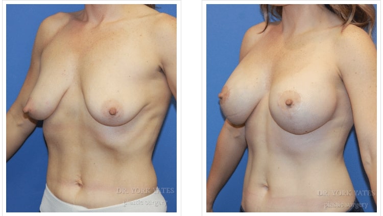 Breast Lift Utah