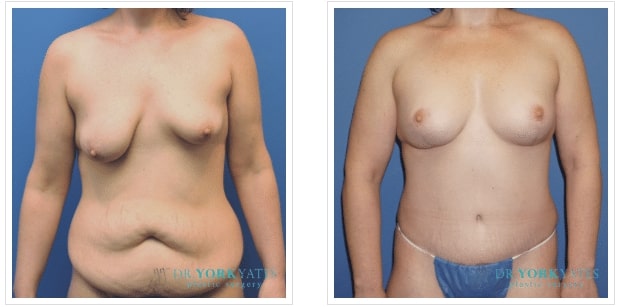 Breast Lift Salt lake city