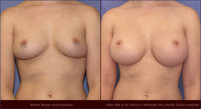 breast-augmentation-23