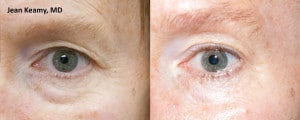 thermismooth eyelid treatment in salt lake city utah 300x120 1