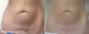 thermitight abdomen photo in Salt Lake City Utah 300x115 1