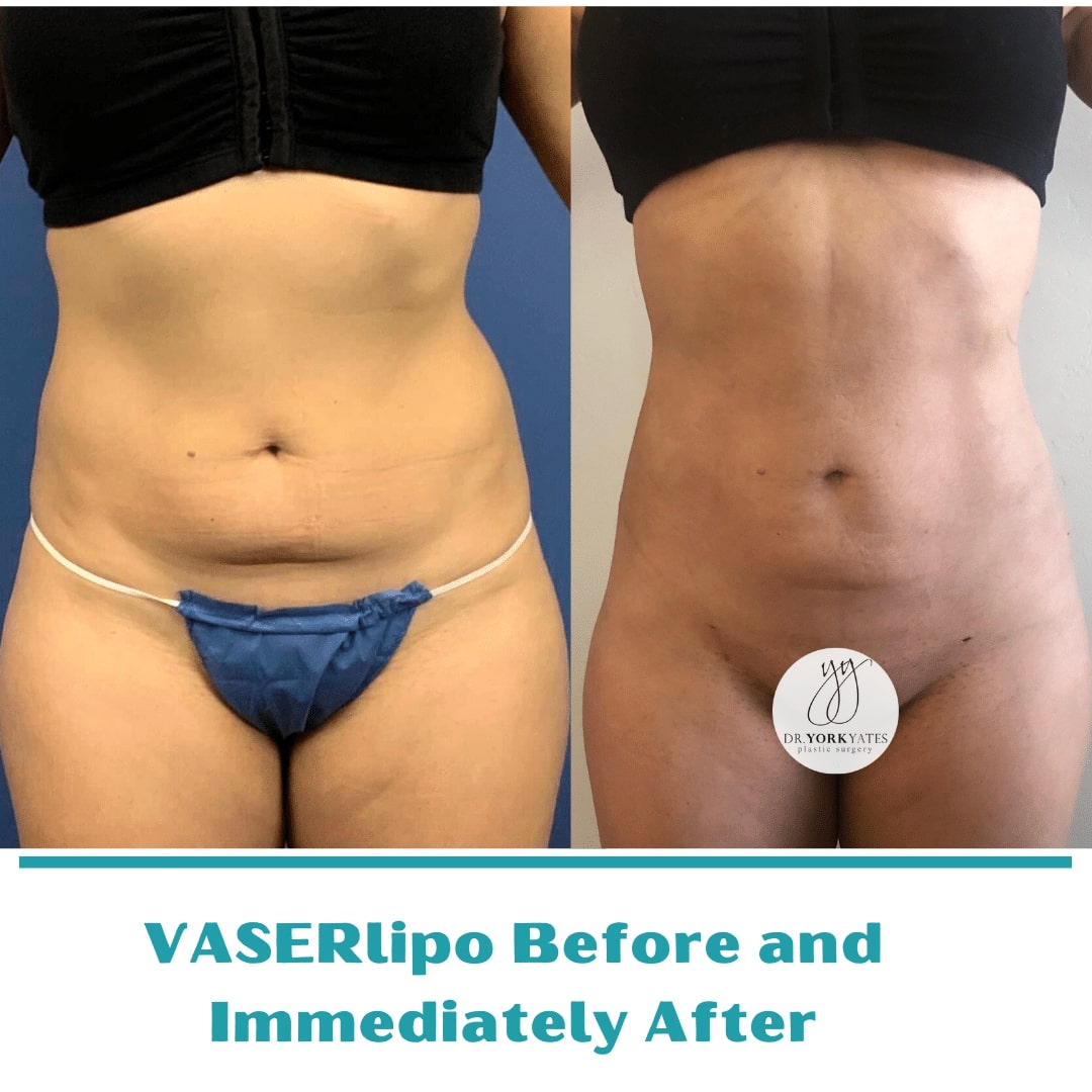 Cost Of Liposuction Austin