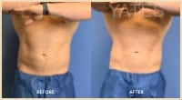 gallery case 10 - Male Body Contouring