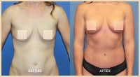 gallery case 11 - Plastic Surgery