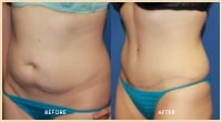 gallery case 12 - Body Contouring