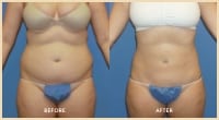 gallery case 2 - Body Contouring