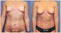 gallery case 3 - Breast Surgery