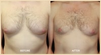 gallery case 4 - Gynecomastia Patient