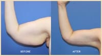 gallery case 7 - Arm Contouring