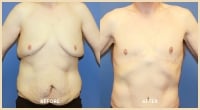 gallery case 8 - Body Contouring