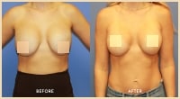 gallery case 9 - Breast Surgery