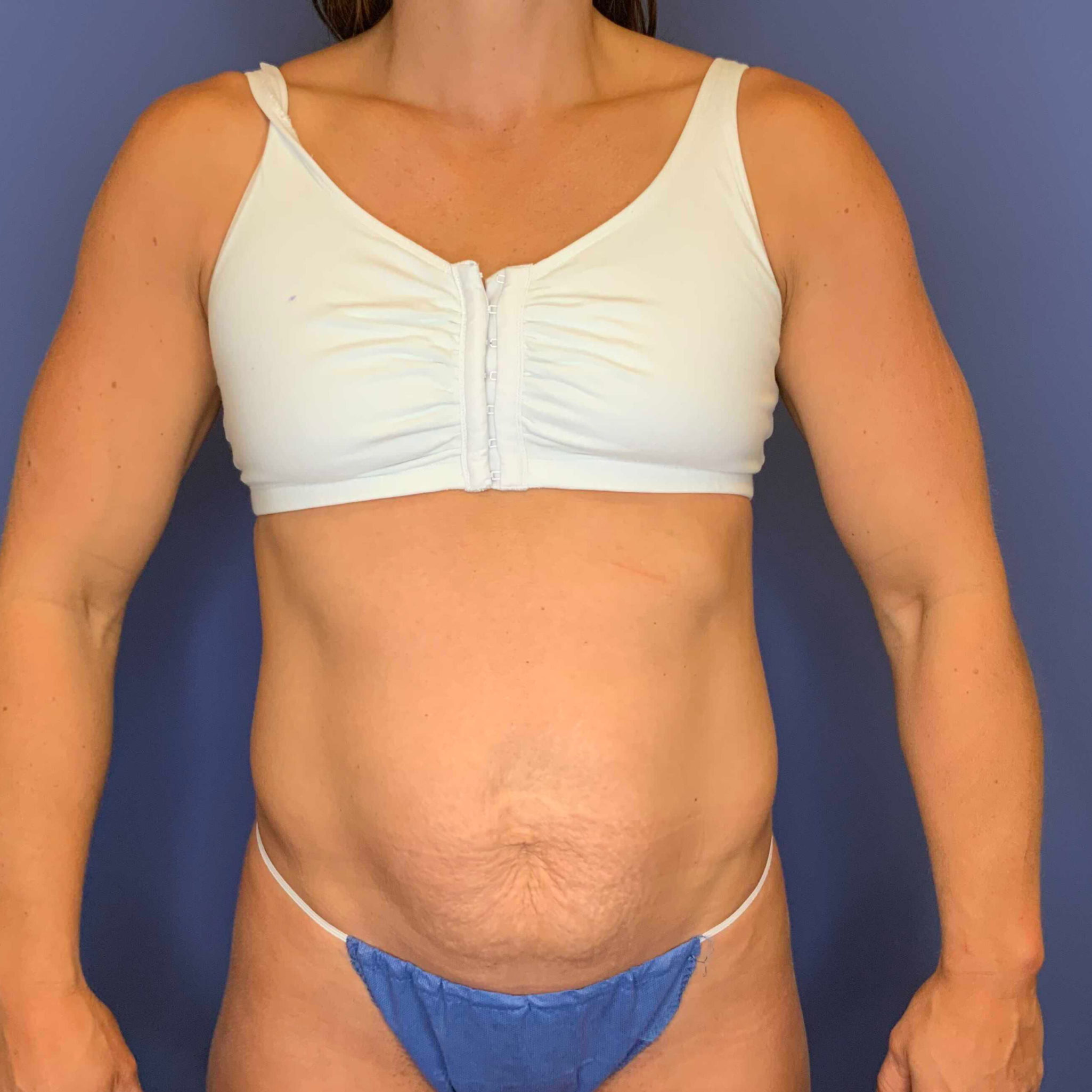 Before Image: Patient 43384 - front