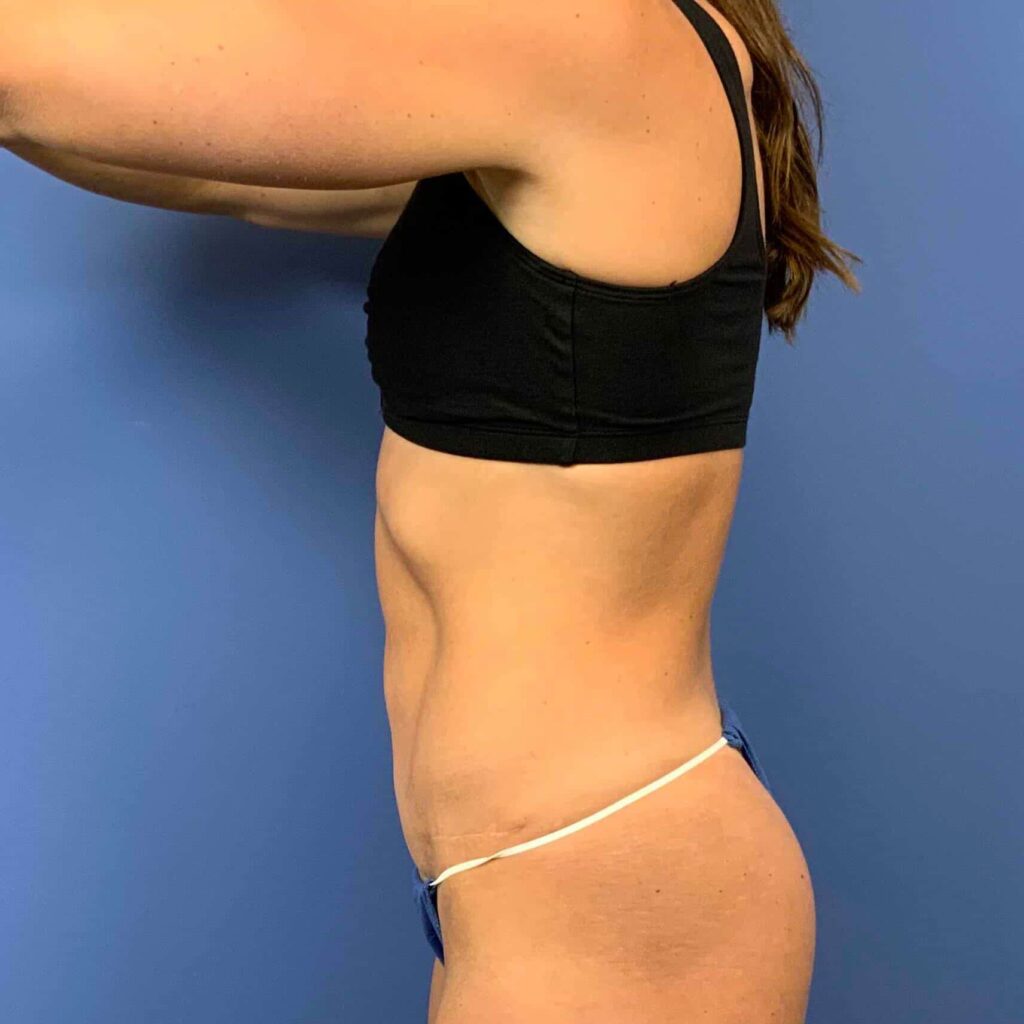 After Image: Patient 43384 - left-side