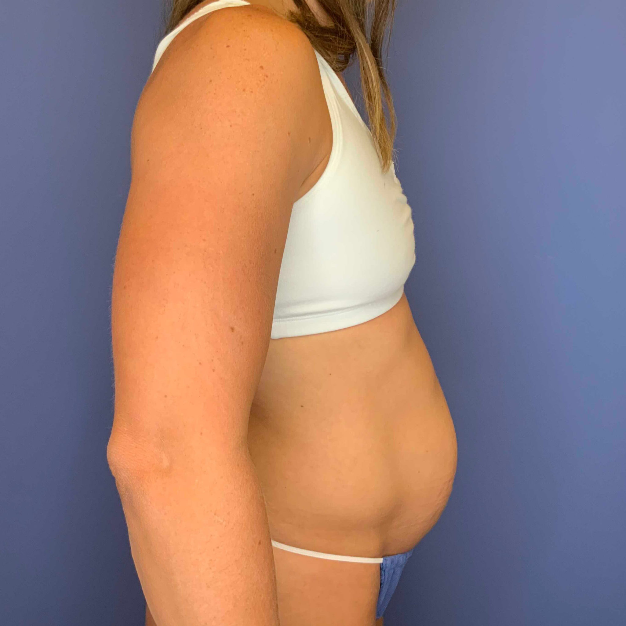 Before Image: Patient 43384 - right-side