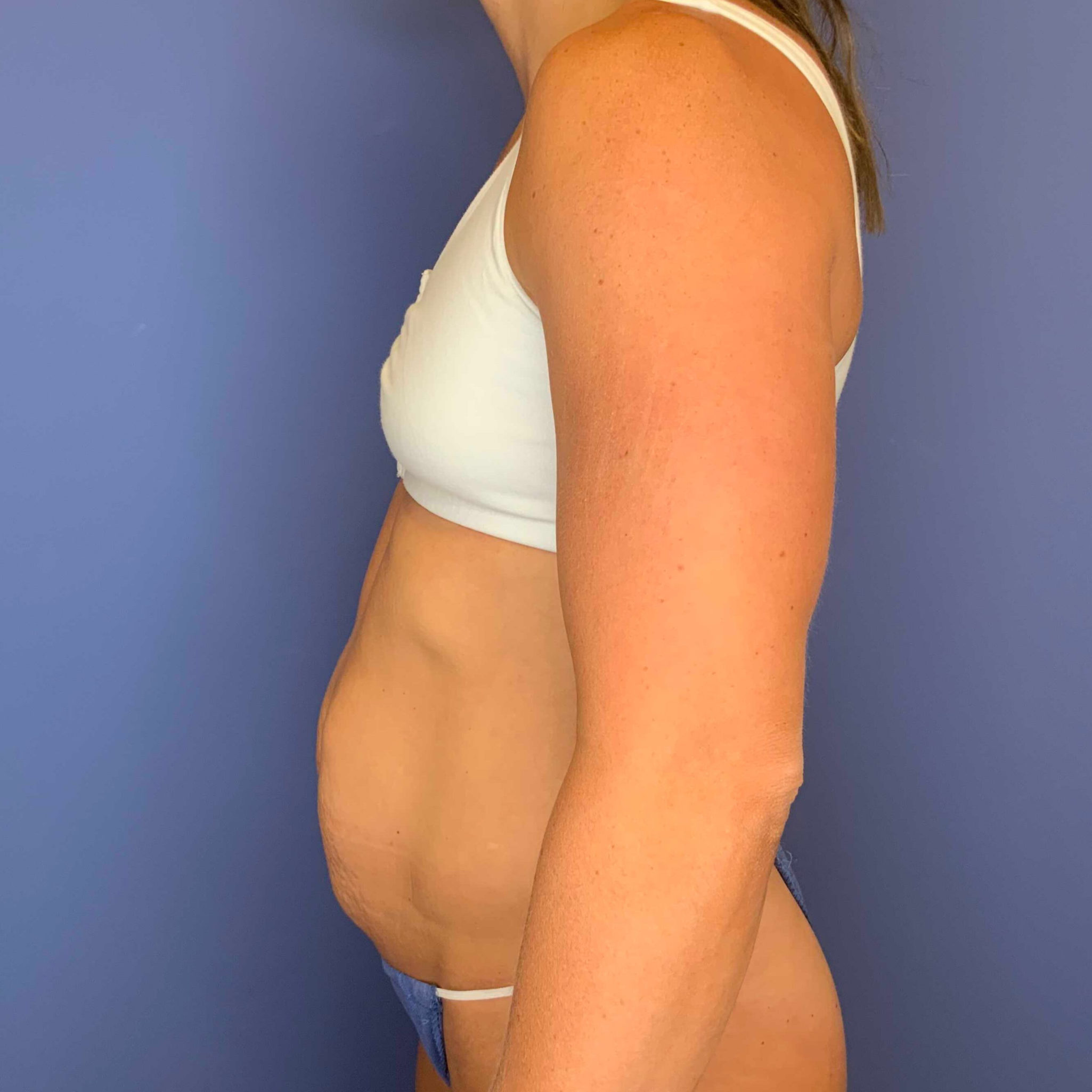 Before Image: Patient 43384 - left-side