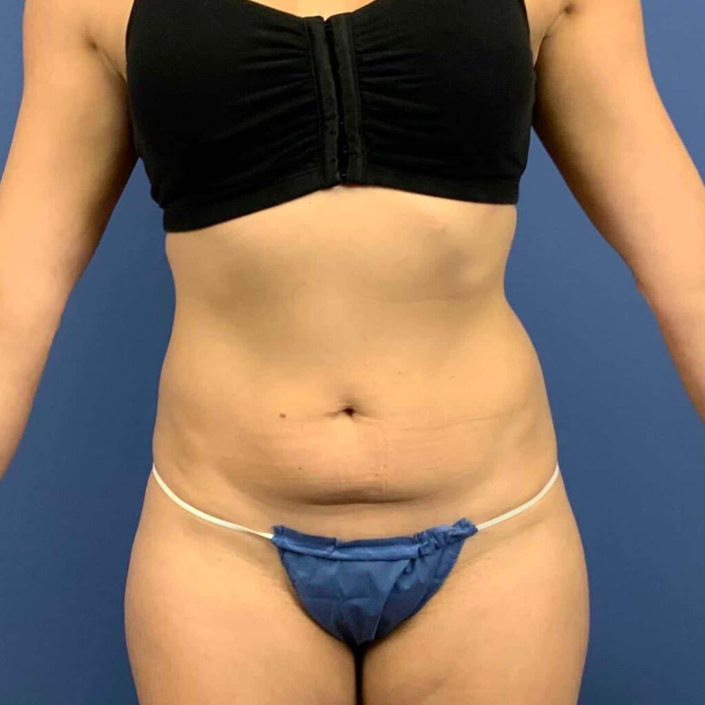 Before Image: Patient 43419 - front