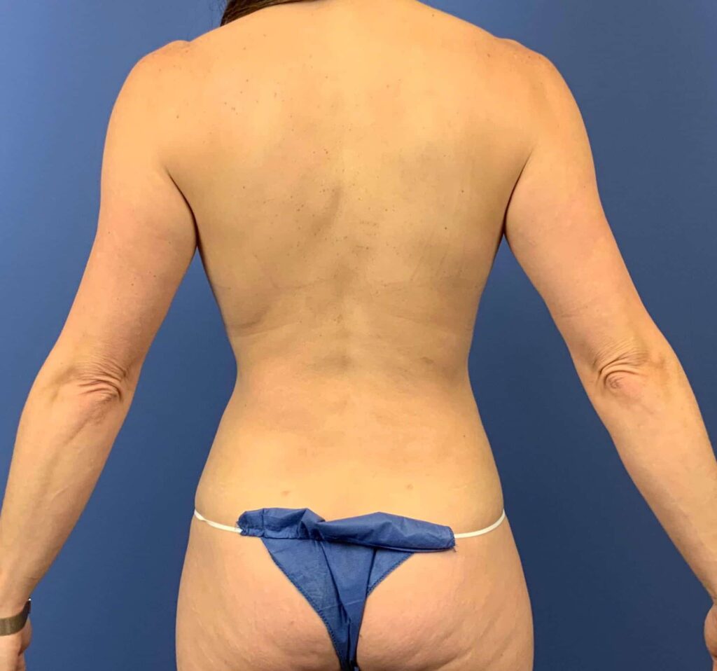 After Image: Patient 43419 - back