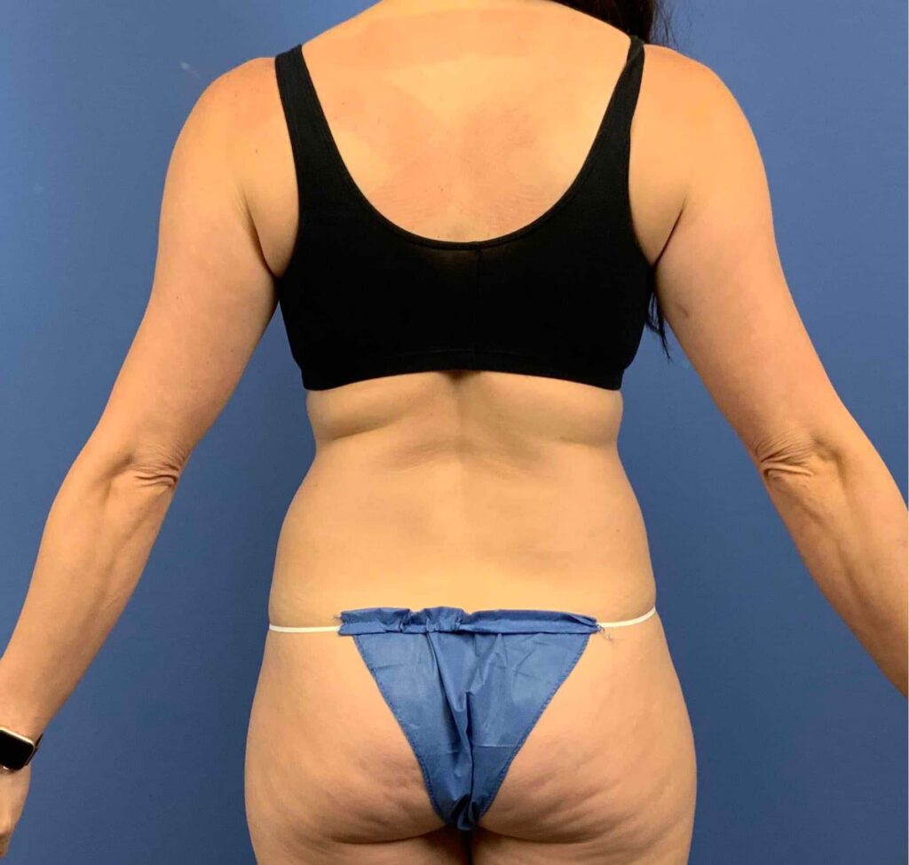 Before Image: Patient 43419 - back