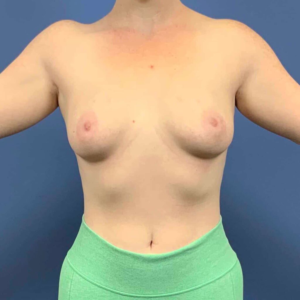 Before Image: Patient 43485 - front