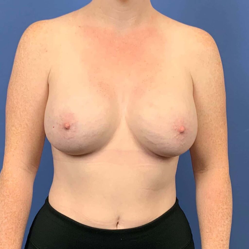 After Image: Patient 43485 - front