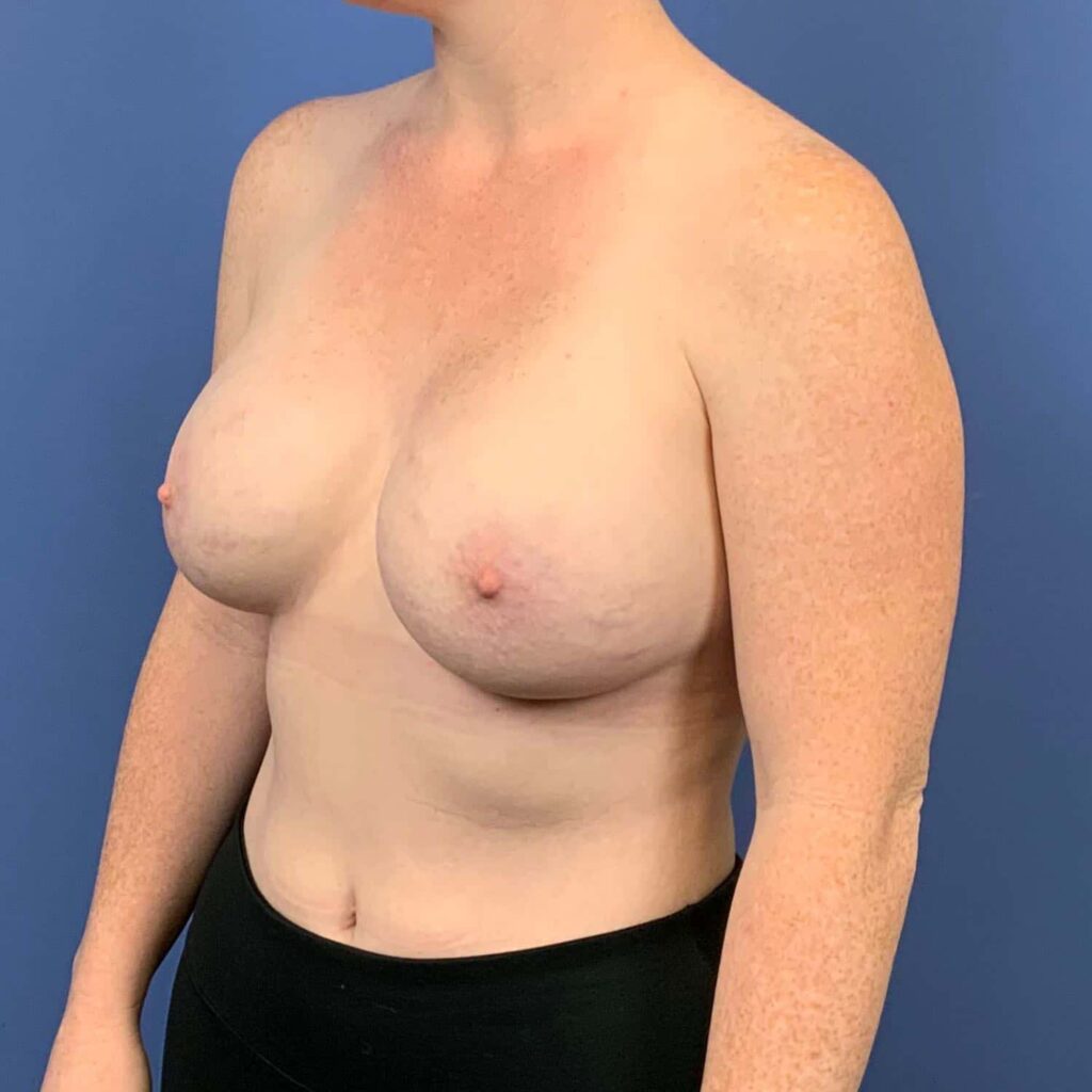 After Image: Patient 43485 - left-front-oblique
