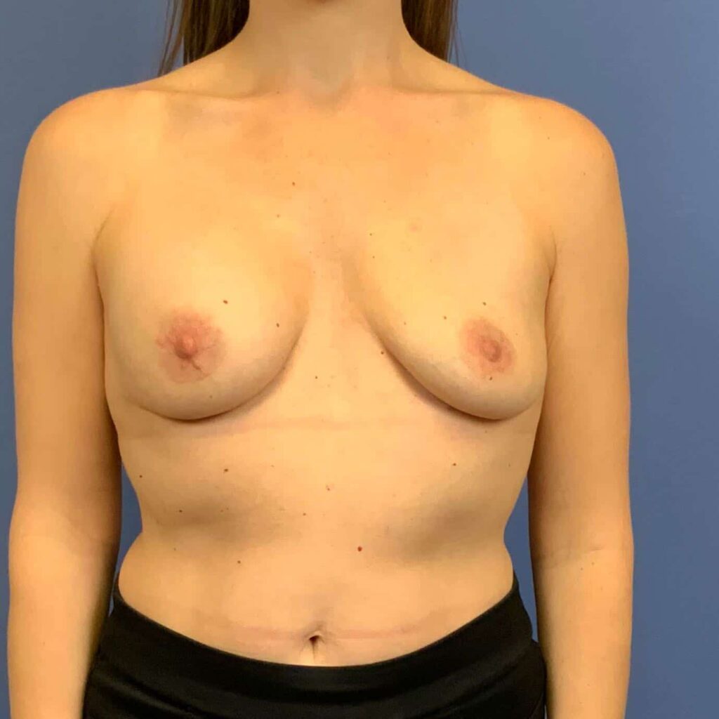 Before Image: Patient 43501 - front