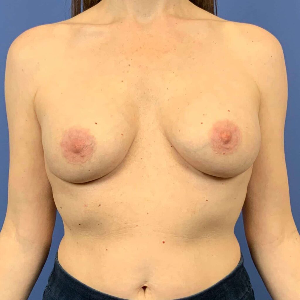 After Image: Patient 43501 - front