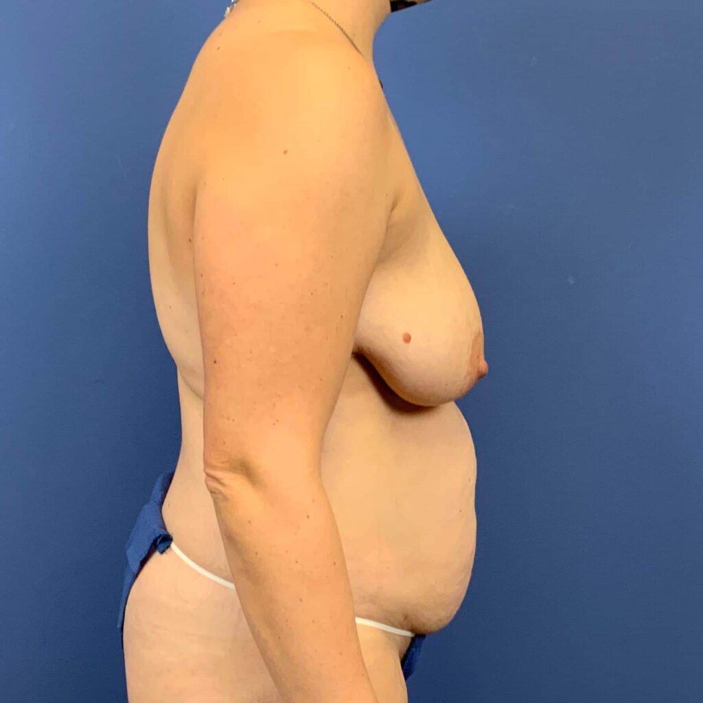 Before Image: Patient 43424 - right-side