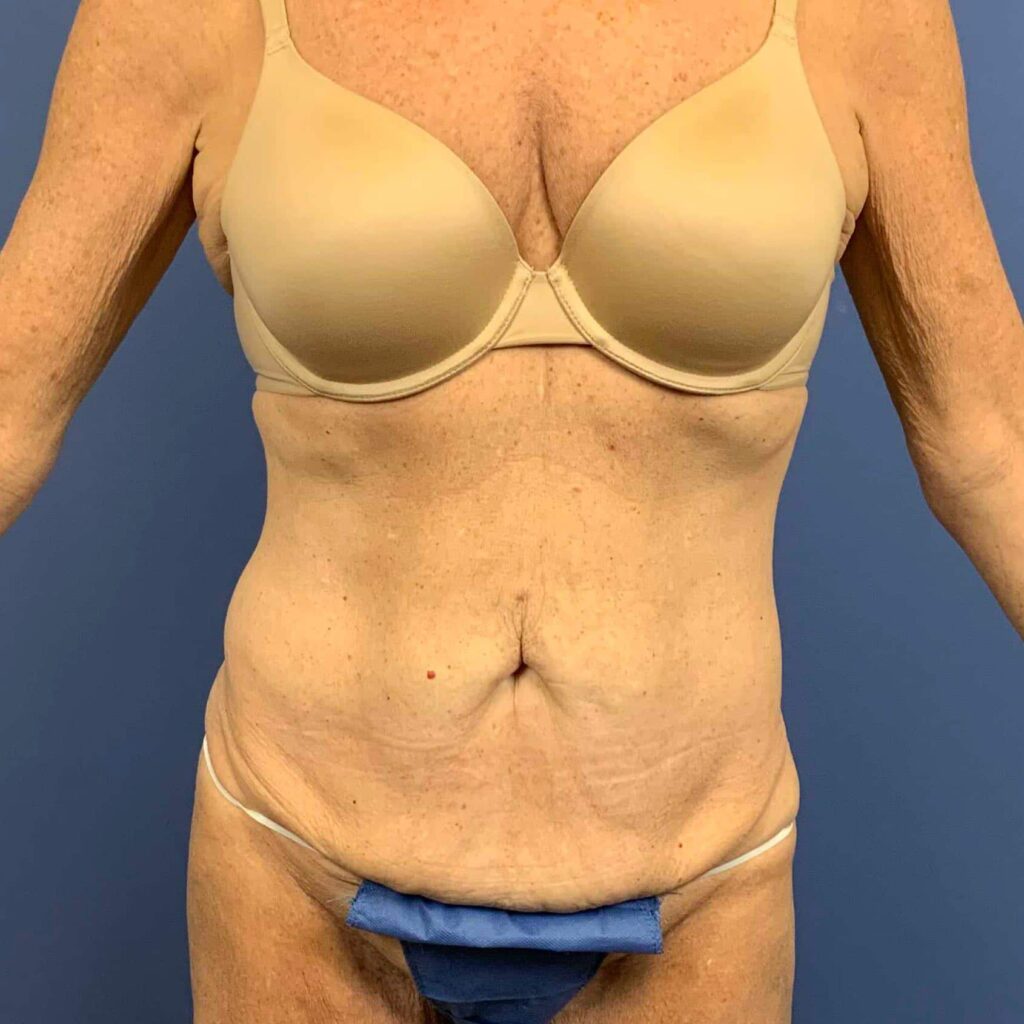 Before Image: Patient 43461 - front