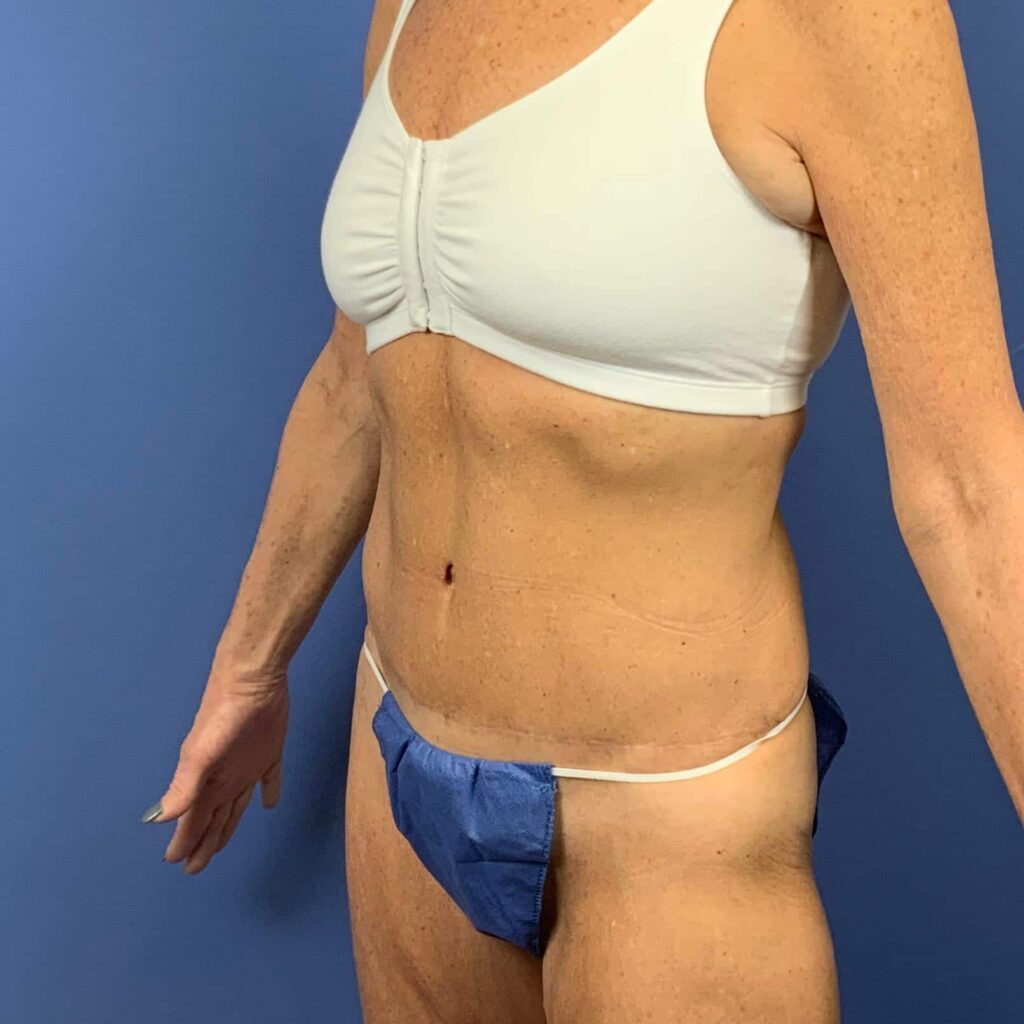 After Image: Patient 43461 - left-front-oblique