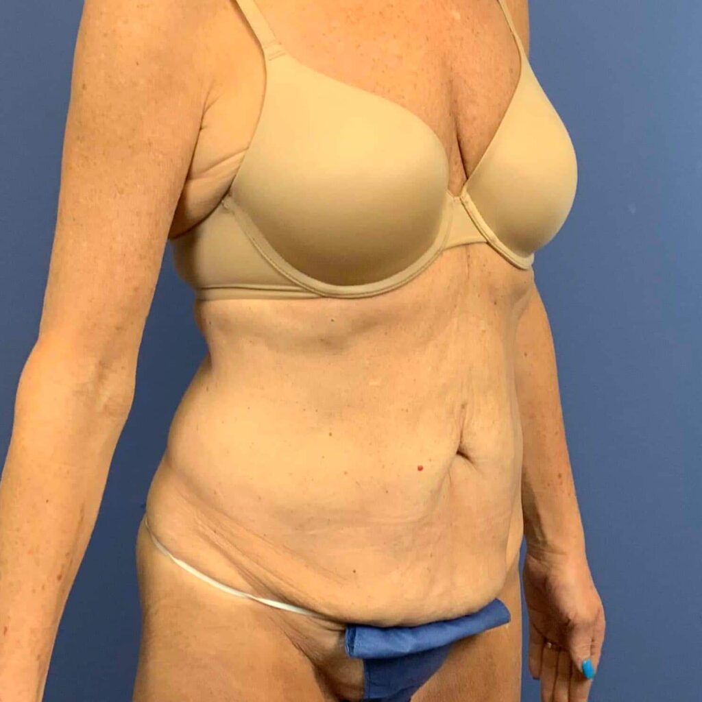 Before Image: Patient 43461 - right-front-oblique