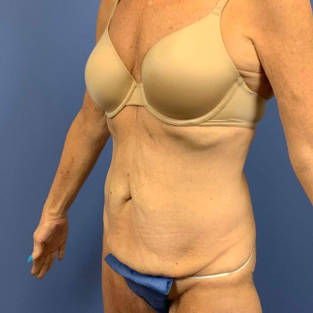 Before Image: Patient 43461 - left-front-oblique