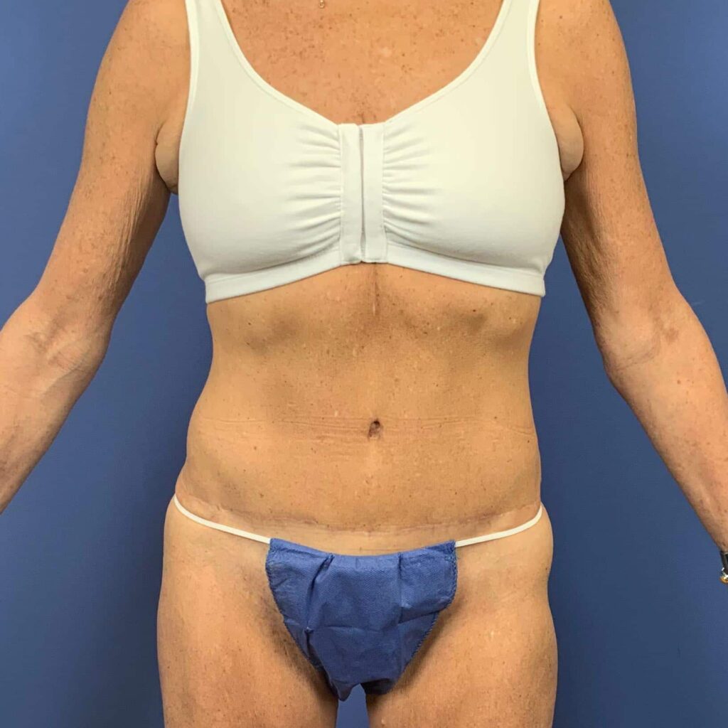 After Image: Patient 43461 - front